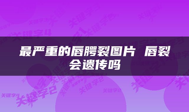 最严重的唇腭裂图片 唇裂会遗传吗
